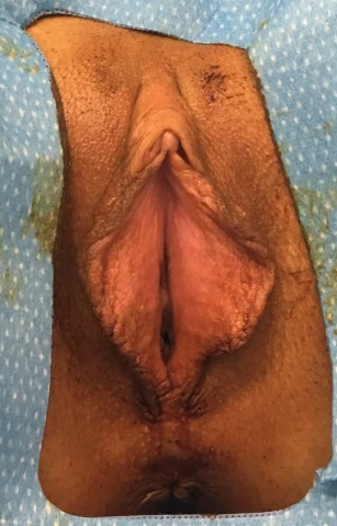Labiaplasty Before & After – Dr. Sean Kelishadi, Newport Beach, CA. Image 1 of 1