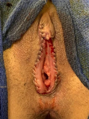 Labiaplasty Before & After – Dr. Dale Reynolds, El Paso, TX. Image 1 of 1