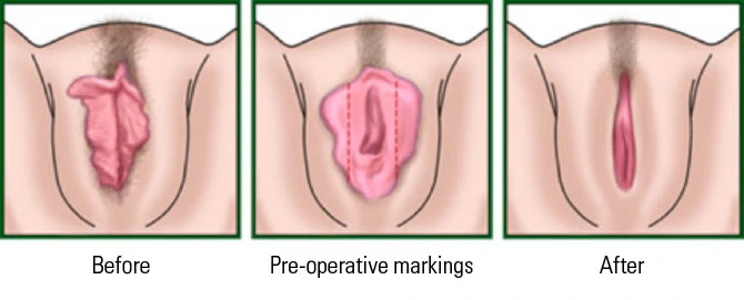 Diagram showing labia minora extending beyond labia majora, overlaid with dashed lines marking planned excision borders, and a post-operative view with the labia minora trimmed to a smooth, symmetrical contour within the labia majora.