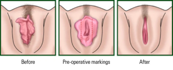Diagram showing labia minora extending beyond labia majora, overlaid with dashed lines marking planned excision borders, and a post-operative view with the labia minora trimmed to a smooth, symmetrical contour within the labia majora.