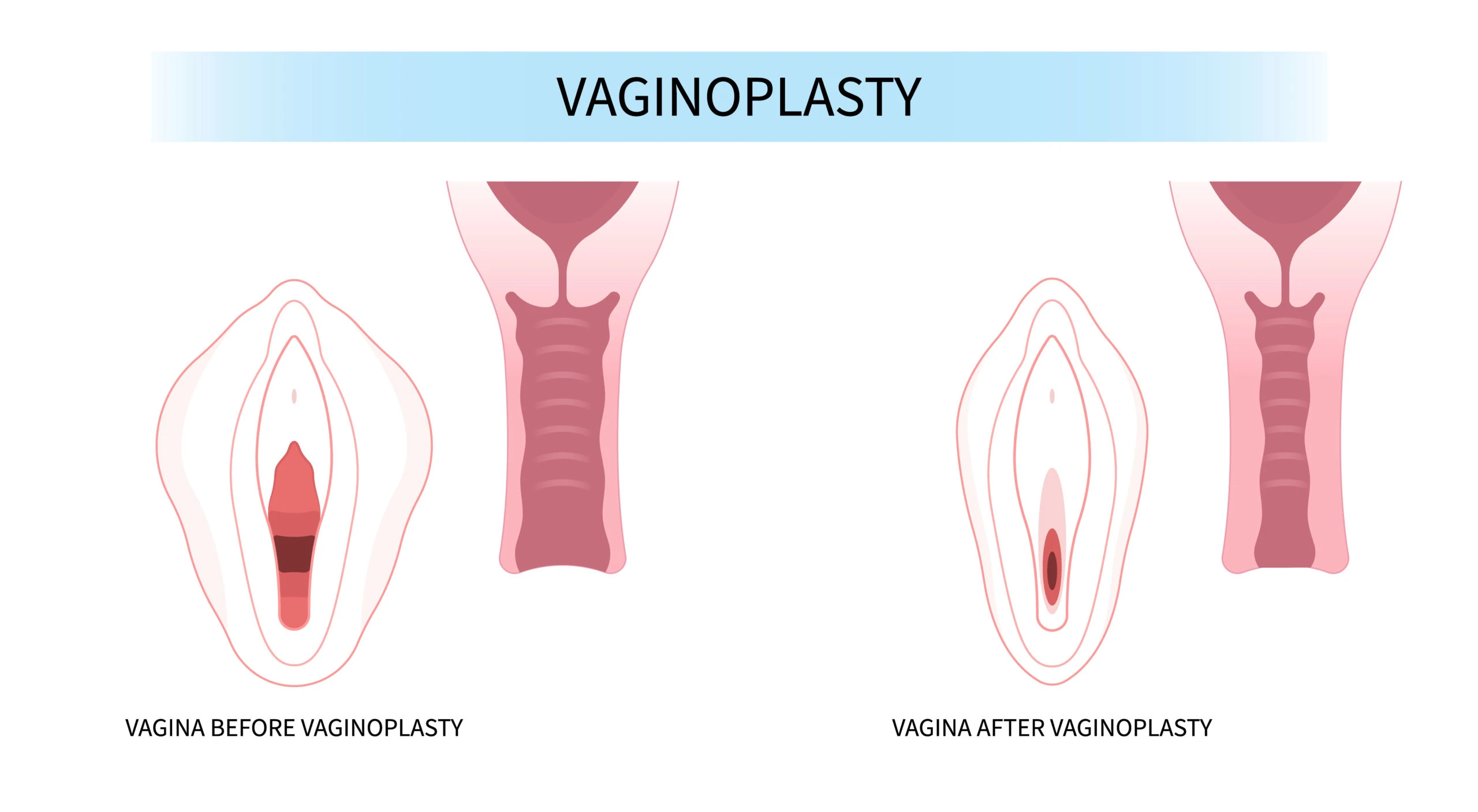 Before and after vaginoplasty: pre-op wider vaginal opening; post-op tightened opening with smoother labial contours