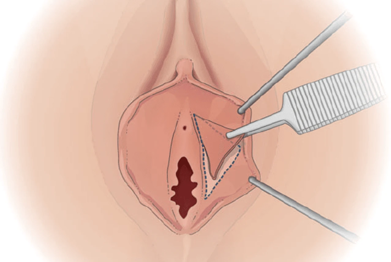De-epithelialization labiaplasty diagram showing marked area of labia minora to be removed for tissue volume reduction