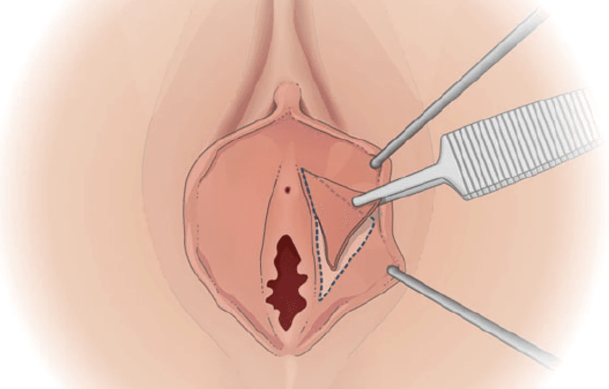 De-epithelialization labiaplasty diagram showing marked area of labia minora to be removed for tissue volume reduction