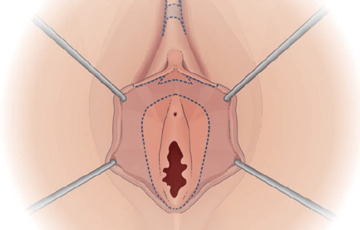 Composite labiaplasty diagram showing marked tissue areas for removal including labia minora and clitoral hood for enhanced contour and symmetry
