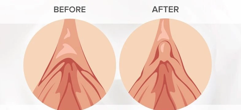 Clitoral hood reduction before and after photo showing reduced tissue and improved clitoral visibility
