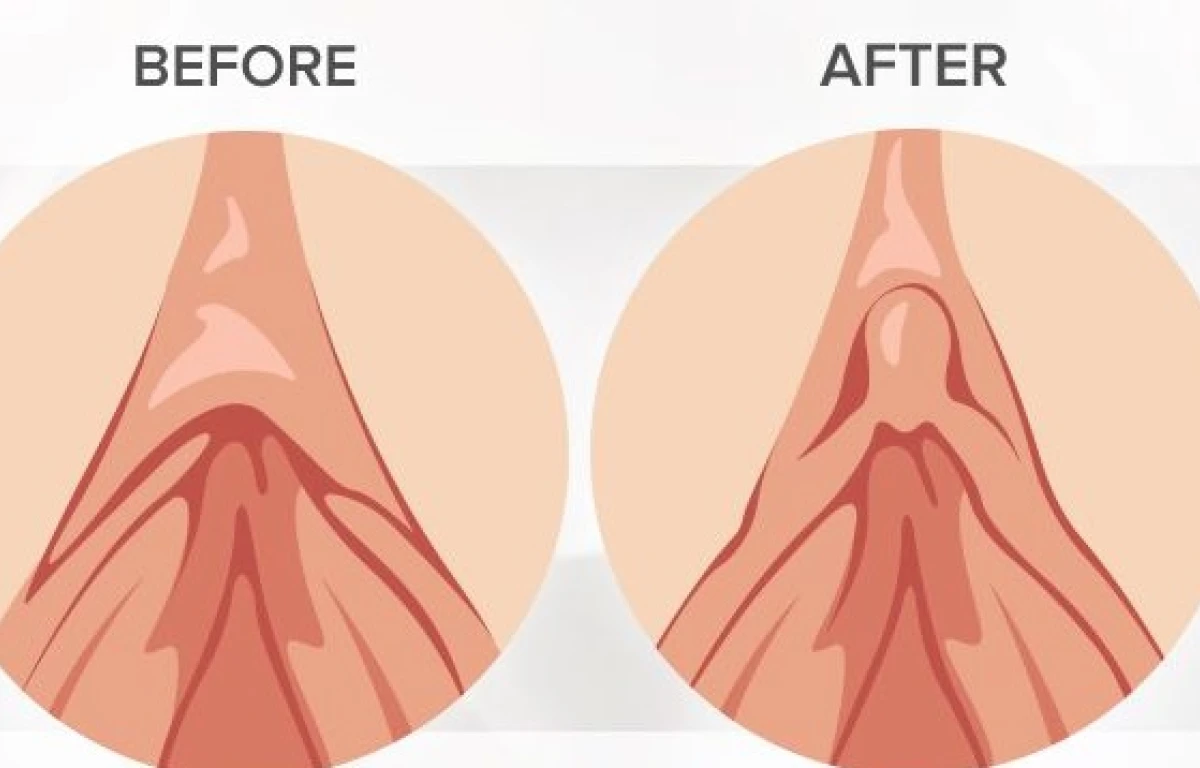 Clitoral hood reduction before and after photo showing reduced tissue and improved clitoral visibility
