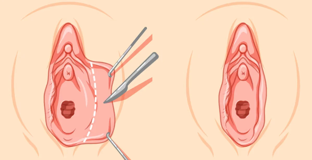 Trim labiaplasty before and after photo showing labia minora reduction and improved genital appearance
