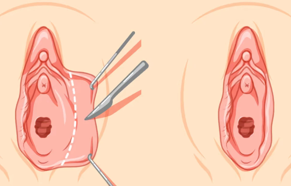 Trim labiaplasty before and after photo showing labia minora reduction and improved genital appearance