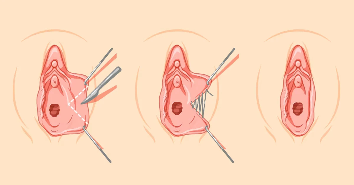 Wedge labiaplasty before and after photo showing labia minora reshaping with natural contour preservation