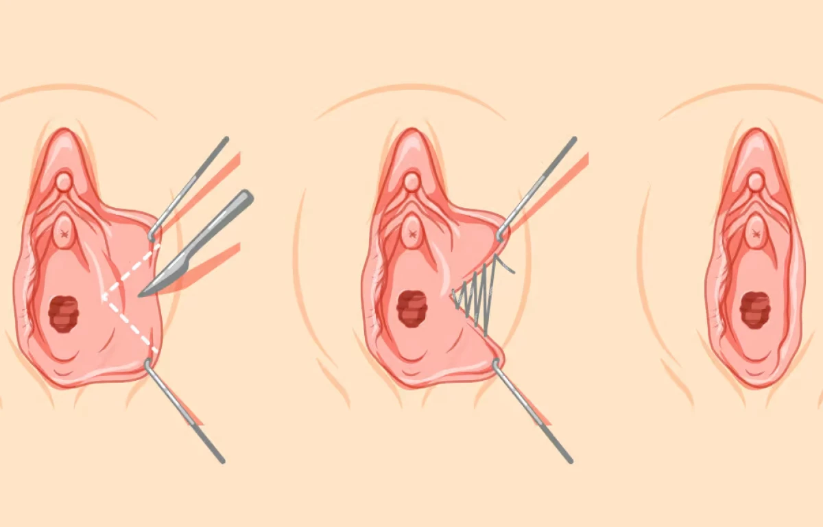 Wedge labiaplasty before and after photo showing labia minora reshaping with natural contour preservation