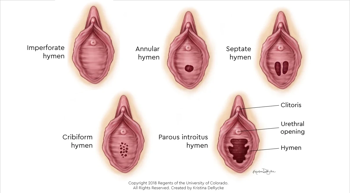Illustration showing various types of hymens, including annular, septate, cribriform, parous, and imperforate, for educational purposes.