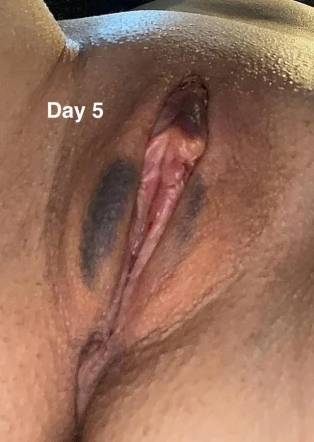 5 Days Post-Op Labiaplasty & CHR: A Journey to Comfort and Confidence