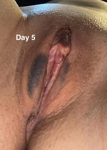 5 Days Post-Op Labiaplasty & CHR: A Journey to Comfort and Confidence. Image 5 of 5
