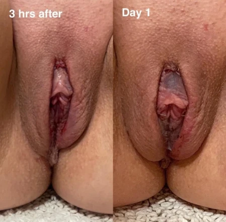 5 Days Post-Op Labiaplasty & CHR: A Journey to Comfort and Confidence