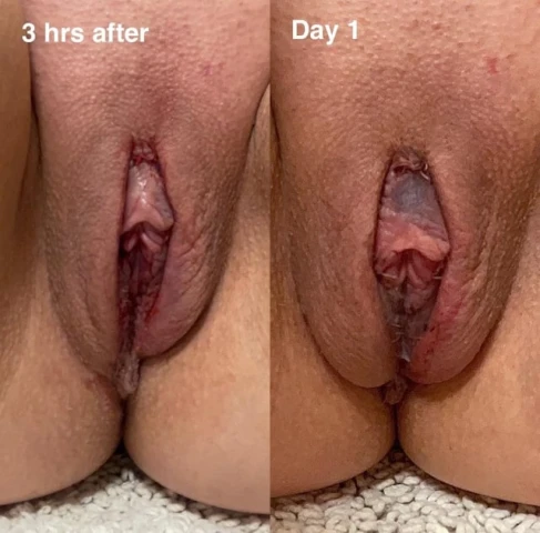 5 Days Post-Op Labiaplasty & CHR: A Journey to Comfort and Confidence. Image 3 of 5