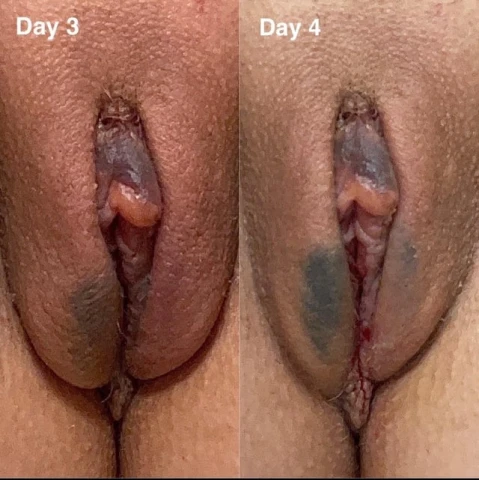 5 Days Post-Op Labiaplasty & CHR: A Journey to Comfort and Confidence. Image 4 of 5