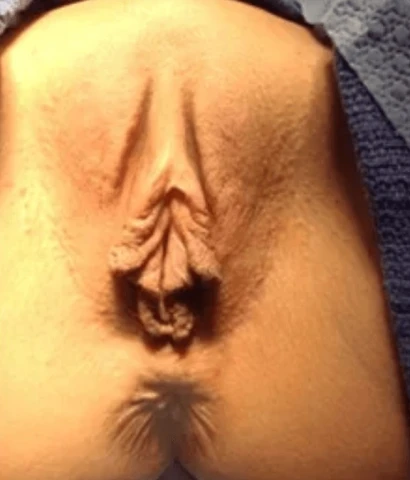 Labiaplasty @ Hedden, Gunn, and Halka Plastic Surgery, Birmingham, AL. Image 1 of 2