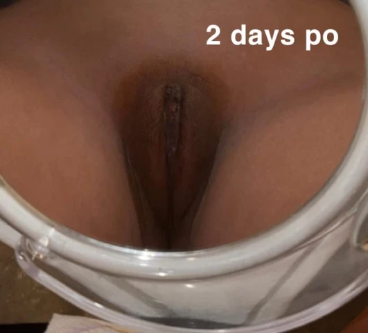 The Final Touches: How Labiaplasty and CHR Results Are Still Evolving. Image 5 of 9
