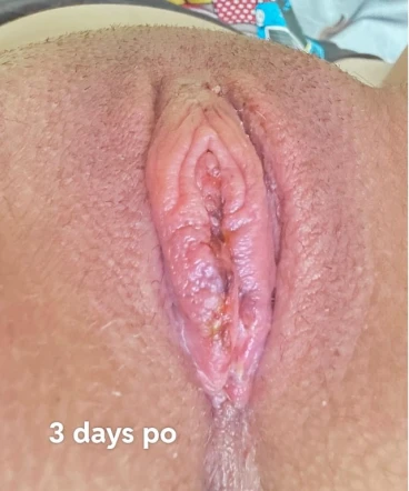 From Panic to Patience: A 72-Hour Post-Op Reality Check