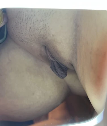 3 Months Later: A Labiaplasty Success Story