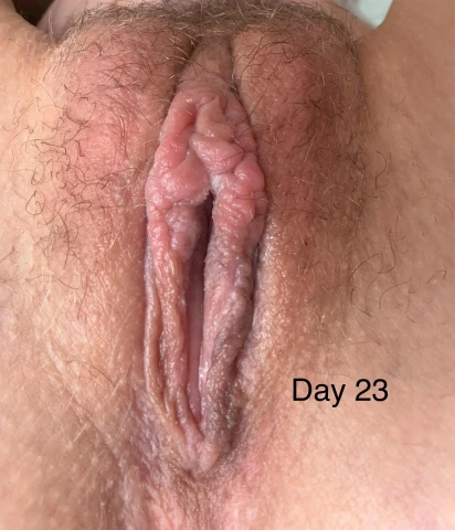 3-Week Labiaplasty & CHR Update: Healing Challenges & Progress. Image 12 of 12