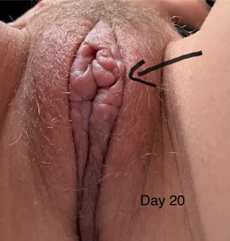 3-Week Labiaplasty & CHR Update: Healing Challenges & Progress. Image 7 of 12