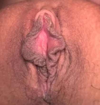 9 Days Post-Labiaplasty: Healing Progress with Before Photos