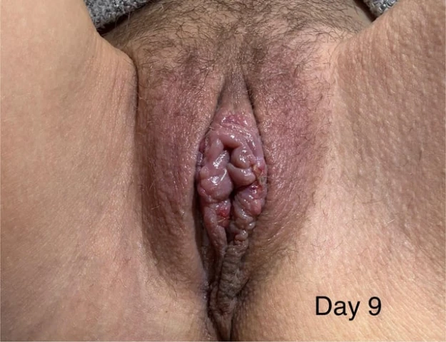 Returning to Work After Labiaplasty: A 14-Day Reality Check. Image 1 of 6