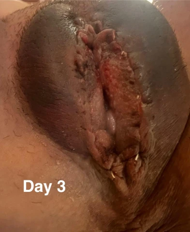V-Trim Labiaplasty in Plymouth, MN: An Early Recovery Journey. Image 12 of 15