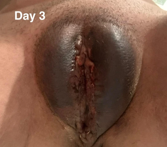 V-Trim Labiaplasty in Plymouth, MN: An Early Recovery Journey. Image 13 of 15