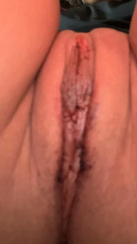 Labiaplasty Recovery Week 3: When Life Gets Back on Track. Image 4 of 4