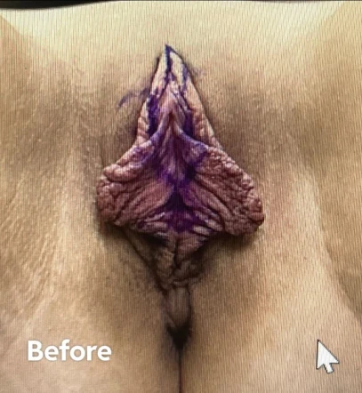 1 Month Post Extended Wedge Labiaplasty: "1000% Worth It"