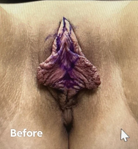 1 Month Post Extended Wedge Labiaplasty: "1000% Worth It". Image 2 of 11