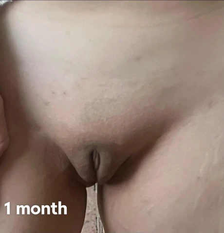 1 Month Post Extended Wedge Labiaplasty: "1000% Worth It". Image 11 of 11