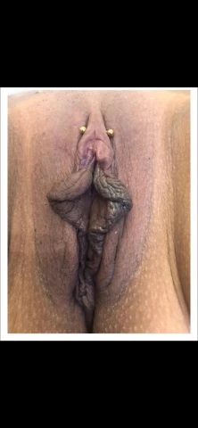 3 Months Post-Labiaplasty: Complete Healing Timeline With Photos. Image 1 of 13