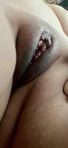 3 Months Post-Labiaplasty: Complete Healing Timeline With Photos. Image 3 of 13
