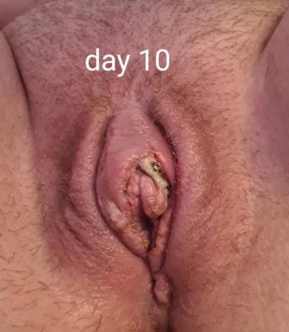 Labiaplasty Day 23 Update: How Results Improved Week by Week. Image 3 of 6