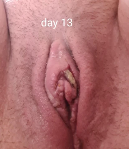 Labiaplasty Day 23 Update: How Results Improved Week by Week. Image 4 of 6