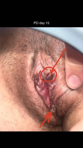 Labiaplasty Without CHR: Top-Heavy Concerns at 2 Weeks. Image 1 of 1