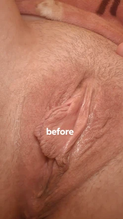Labiaplasty Recovery Day 14: Tracking Swelling Reduction
