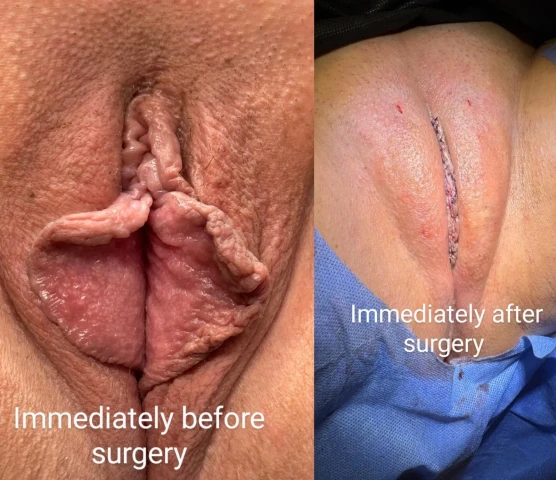 15 Days Post-Op: Feeling Great But Playing It Safe. Image 1 of 3