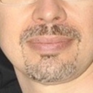 Richard Klein board-certified labiaplasty surgeon