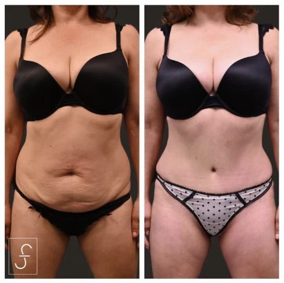 sf-bay-area-plastic-surgery-los-gatos-1.jpg