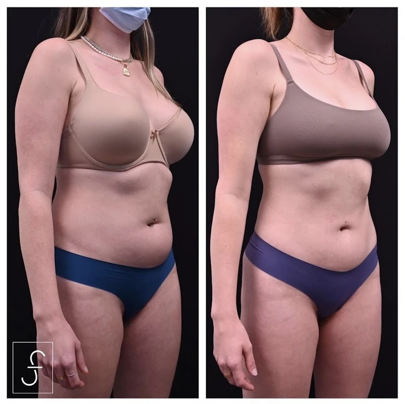 SF Bay Area Plastic Surgery - Los Gatos, Los Gatos, California, 15965