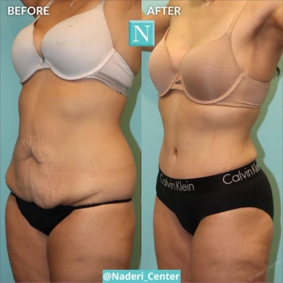 naderi-center-breast-and-body-plastic-surgery-tummy-tuck-mommy-makeover-experts-1.jpg