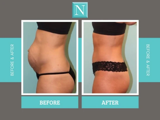 naderi-center-breast-and-body-plastic-surgery-tummy-tuck-mommy-makeover-experts-3.jpg