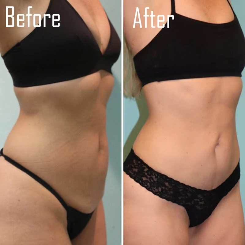 Naderi Center Breast and Body Plastic Surgery - Tummy Tuck & Mommy Makeover Experts, Reston, Virginia, 20190