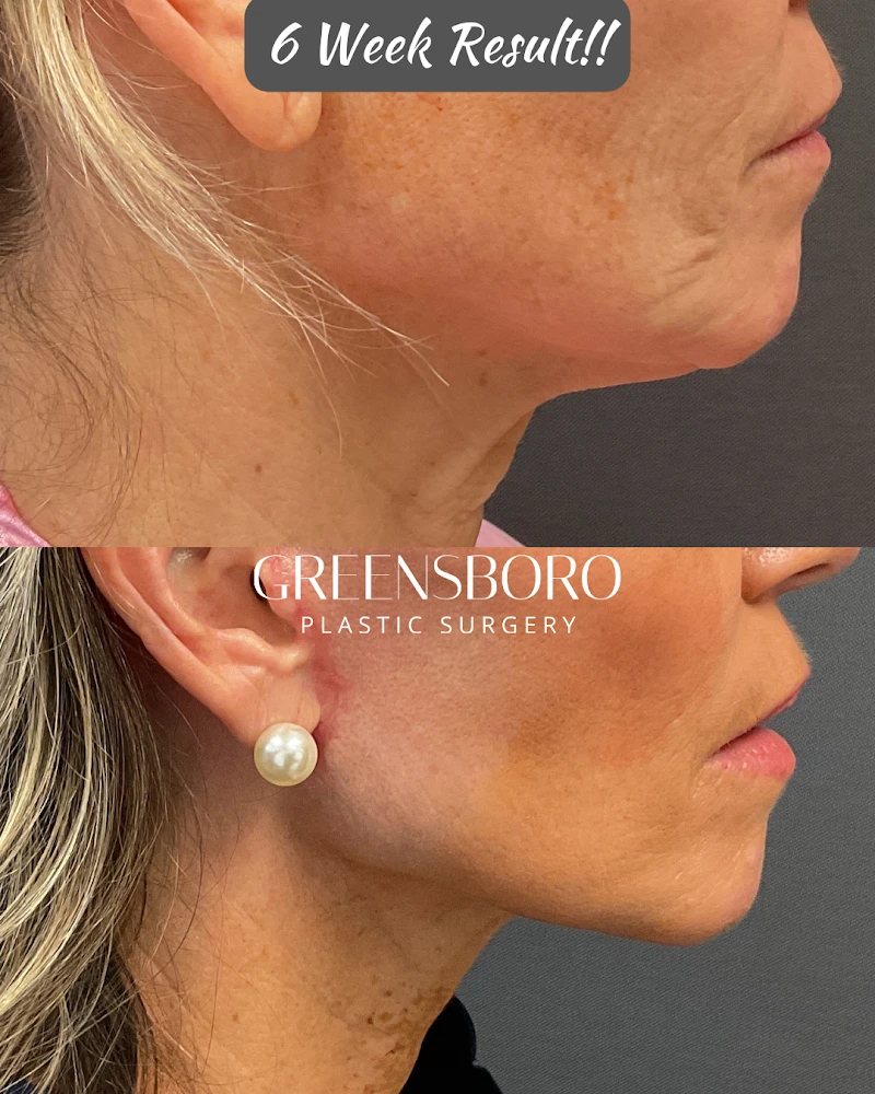 Greensboro Plastic Surgery, Greensboro, North Carolina, 27408