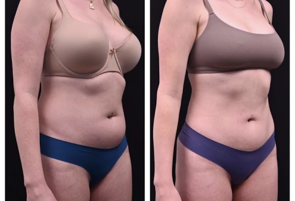 sf-bay-area-plastic-surgery-morgan-hill-2.jpg