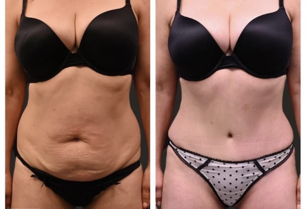 sf-bay-area-plastic-surgery-morgan-hill-3.jpg
